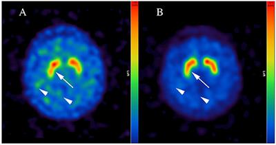 Case Report: Bupropion Reduces the [123I]FP-CIT Binding to Striatal Dopamine Transporter